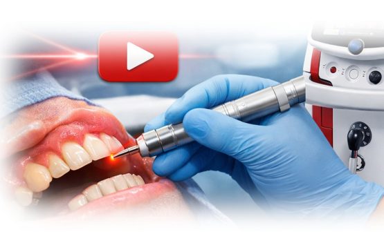 Skaties video par lāzeru LightWalker® AT-S, ko Stomatoloģijas institūta speciālisti izmanto smaganu slimību ārstēšanai!